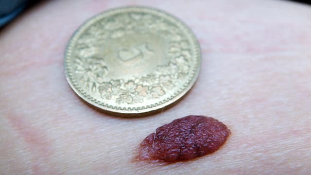 Muttermal mit Fünfräppler Muttermal mit Fünfräppler