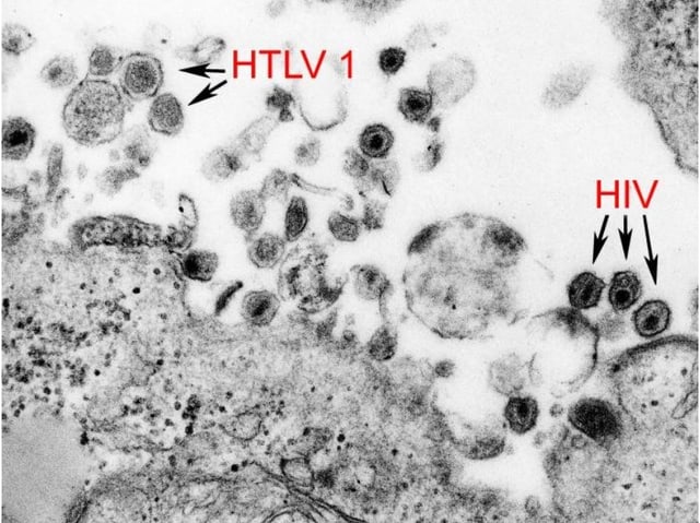 Das Bild zeigt die Präsenz von HTLV1 und HIV in einem menschlichen Organismus. Das Bild zeigt die Präsenz von HTLV1 und HIV in einem menschlichen Organismus.