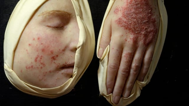 Moulagen mit Hautkrankheiten
