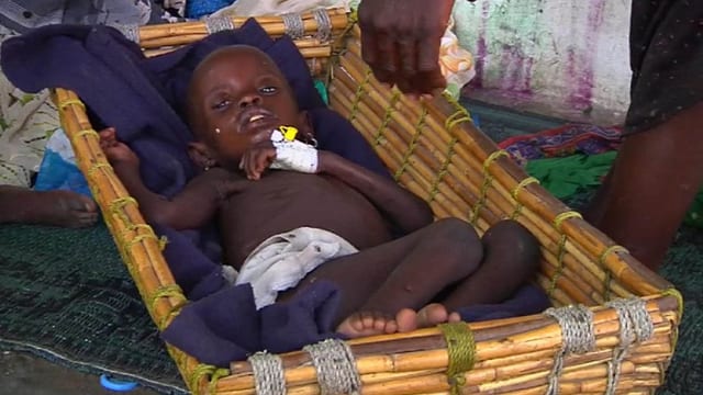 Ein unterernährtes Kind erhält Hilfe von den Médecins Sans Frontières in Südsudan. Ein unterernährtes Kind erhält Hilfe von den Médecins Sans Frontières in Südsudan.