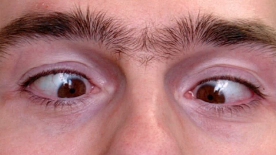 Schielen bei Erwachsenen Ursachen und Behandlung Ratgeber SRF