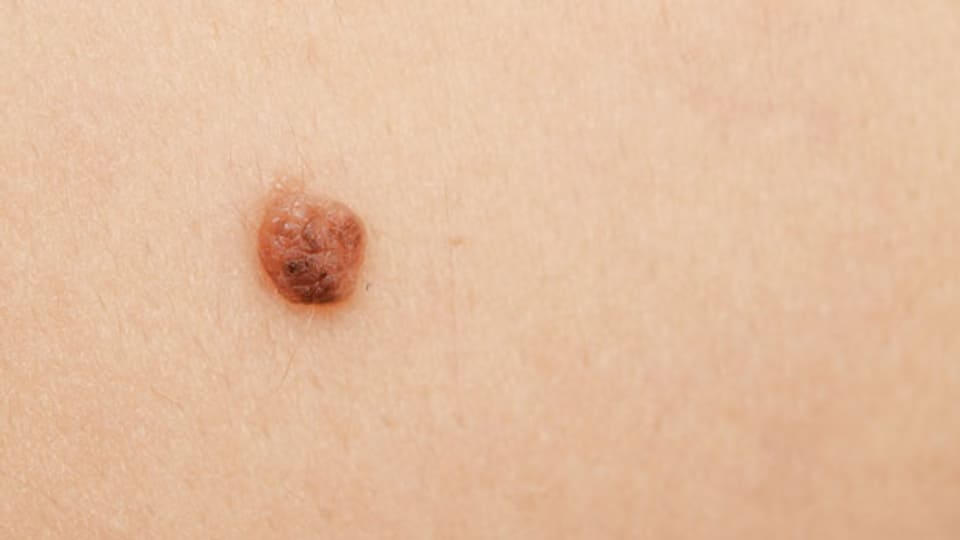 Harmlos? Fünf bis zehn Prozent der Bevölkerung haben ein erhöhtes Risiko, an Hautkrebs zu erkranken.