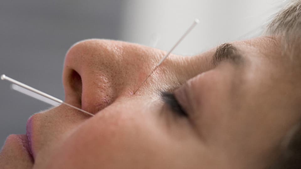 Akupunktur ist eine der populärsten Behandlungsmethoden der Komplementärmedizin.