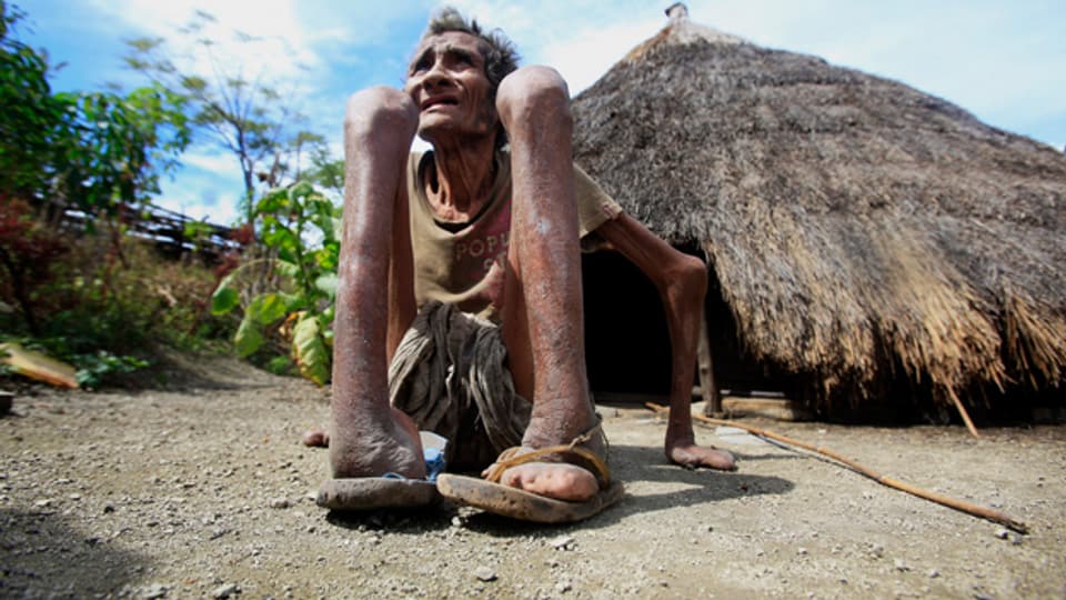 Ein Leprakranker in Osttimor: Lepra ist eine der ältesten bekannten Krankheiten und bis heute nicht ausgerottet.
