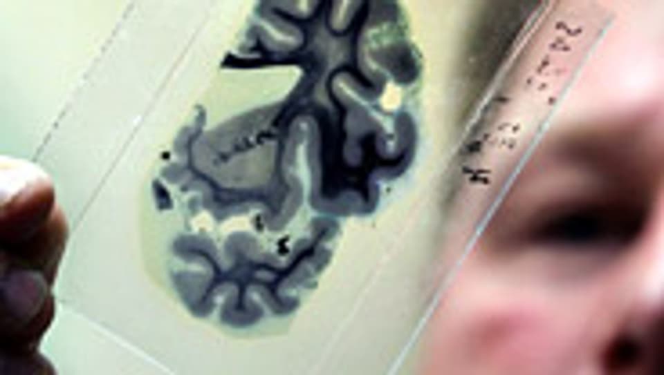 Unklare Diagnose: Alzheimer lässt sich selbst mit einer Autopsie nicht eindeutig feststellen.