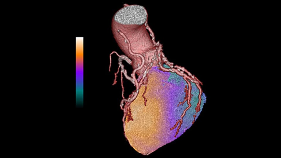 Der Herzmuskel mit den sich von der Hauptschlagader (Aorta) verzweigenden Herzkranzgefaessen. Bläulich-gruenlich gefärbte Teile des Herzens erhalten nicht genügend Sauerstoff, was zum Herzinfarkt führen kann.