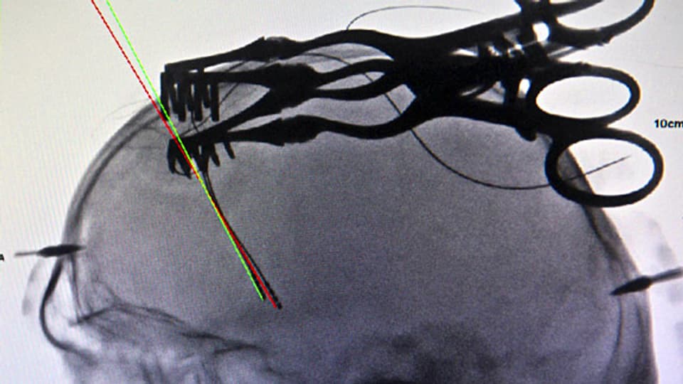 Eine Röntgenaufnahme zeigt implantierte Elektroden im Schädel eines Patienten. Sie sind Teil eines sogenannten Hirnschrittmachers.