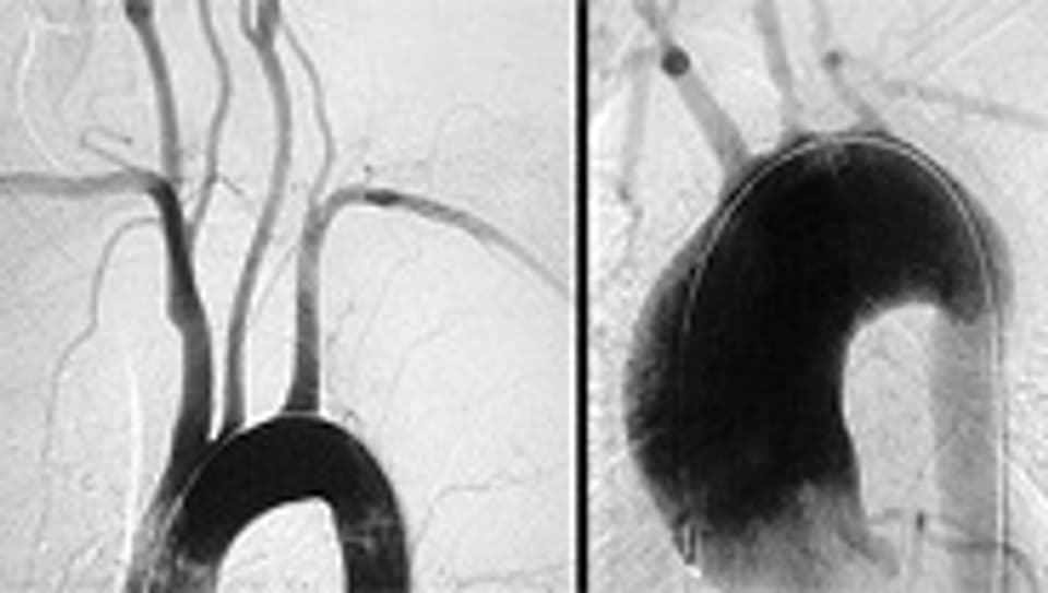 Ein normaler Aortenbogen (links) im Vergleich zu einem Patient mit der seltenen Krankheit Takayasu-Arteriitis.