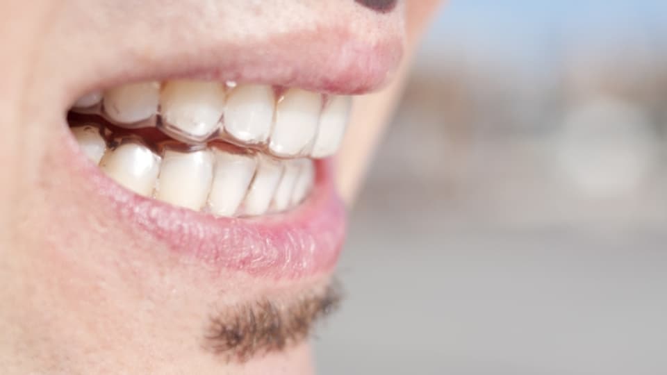 Eine Zahnschiene schützt die Zähne vor Abrieb und leitet Kräfte gleichmässig ab.