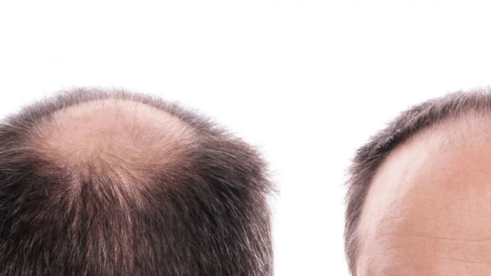 Der Grund für schütteres Haar ist bei Männern und Frauen unterschiedlich.