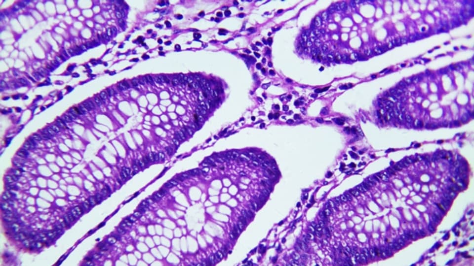 Mikroskopischer Schnitt von Gewebe eines Rektumkarzinom (Enddarmkrebs)