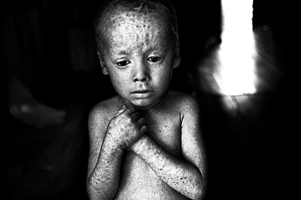 Auwirkungen von landwirtschaftlichen Chemikalien auf die Gesundheit: Ein fünfjähriger Junge mit angeborener Hautkrankheit in Argentinien