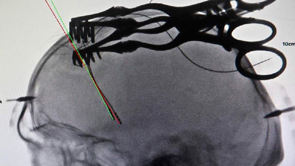 Die Elektroden des sogenannten Hirnschrittmachers beeinflussen mit elektrischen Impulsen einzelne Hirnregionen (Röntgenaufnahme).