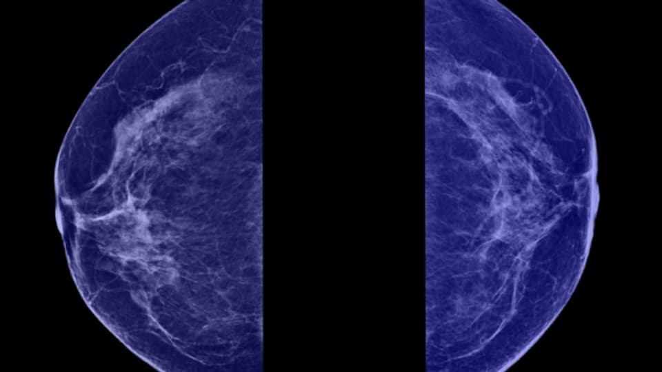Bei rund 30% aller Krebserkrankungen bei Frauen handelt es sich um Brustkrebs.