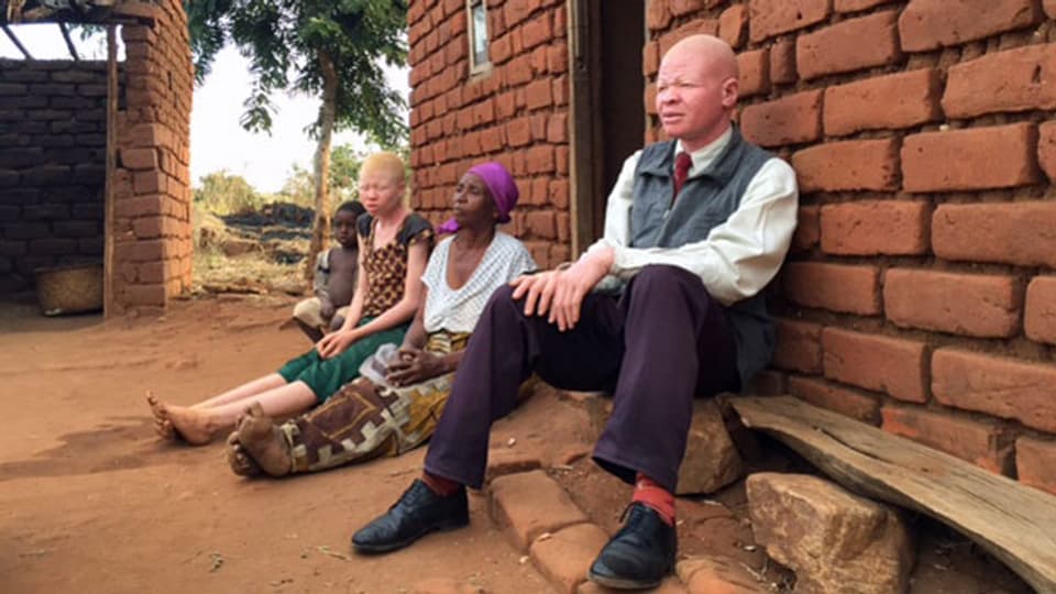 Die 12-jährige Leda leidet, wie auch ihr Onkel unter Albinismus. Aufgrund einer genetischen Störung produziert ihr Körper kaum Melanin, das Pigment, das die Haut vor Sonnenstrahlen schützt und dunkel färbt.