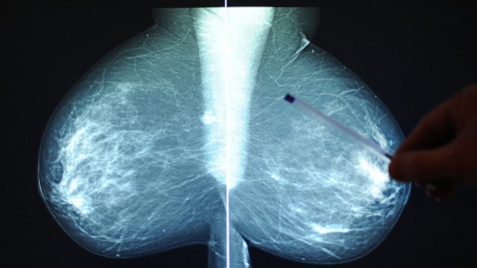Ein Bruströntgenbild. In vielen Kantonen werden Mammografien gratis angeboten.