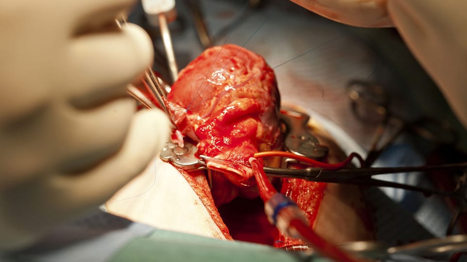 Kinderchirurg Rene Pretre implantiert einem Kleinkind ein neues Herz, aufgenommen am Ende 2011 in Zürich. Es ist in der Schweiz die zweite Herztransplantation an einem Kind im ersten Altersjahr.
