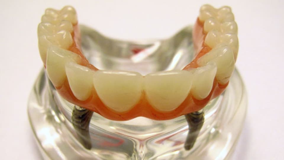 Modell eines Zahnimplantats von Nobel Biocare.