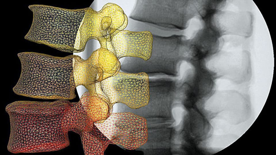 Seit dem letzten Jahr läuft ein Pilotprogramm. Nun gilt es ernst: Als erstes werden Kniegelenksspiegelungen angeschaut, Eingriffe an der Wirbelsäule und die Verabreichung von Eisen an Patientinnen, die nicht an Blutarmut leiden. Bild: Ein Mustererkennungsprogramm wandelt das Röntgenbild einer Wirbelsäule in ein 3D-Bewegungsmodell um.