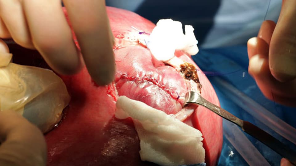 Vorgeburtliche Operation am offenen Rücken eines Fötus‘ am Kinderspital Zürich.
