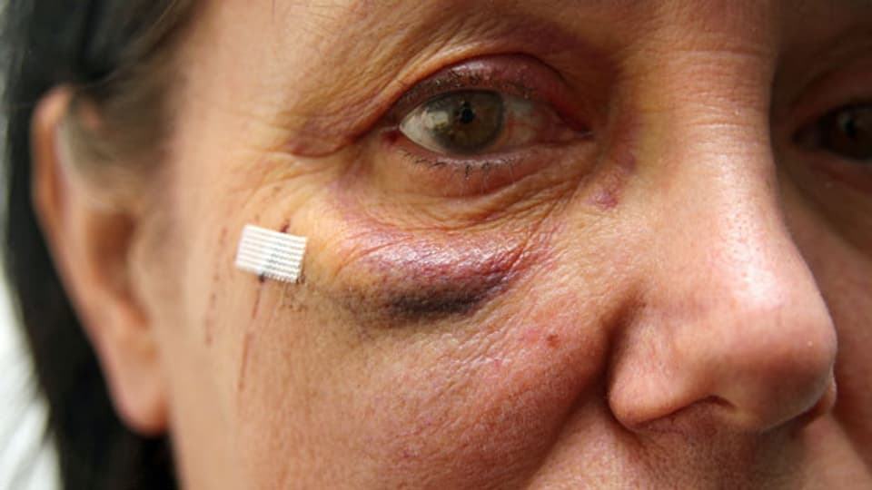 Frau mit Gesichtsverletzung. Symbolbild.