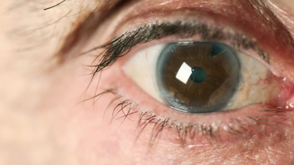 Beim Grauen Star trübt sich die Linse hinter der Pupille. Die Trübung erzeugt einen Grauton.