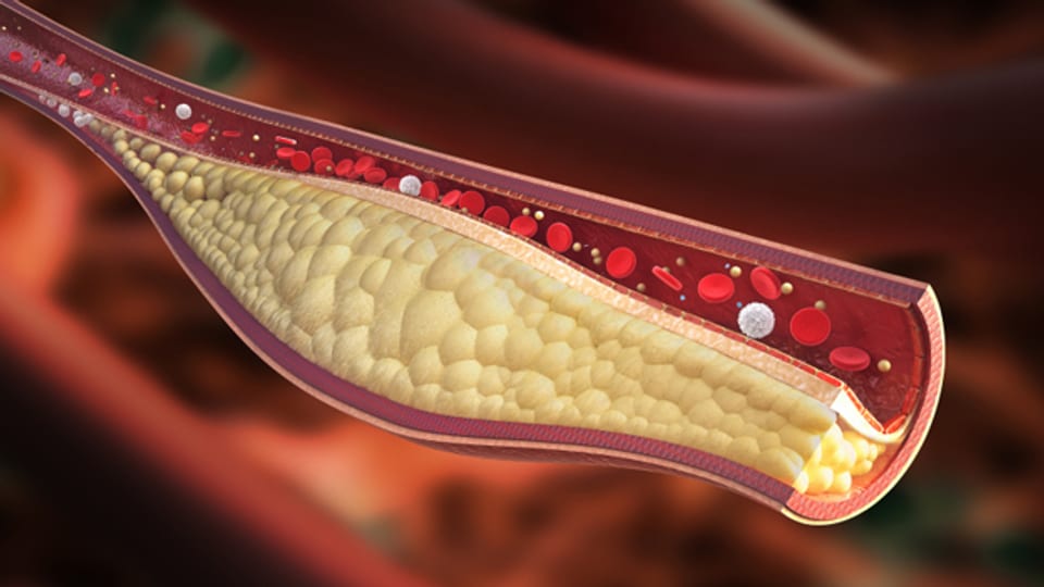 LDL-Cholesterin lagert sich in den Blutgefässen ab und führt zu Arterienverkalkung oder -verengung.