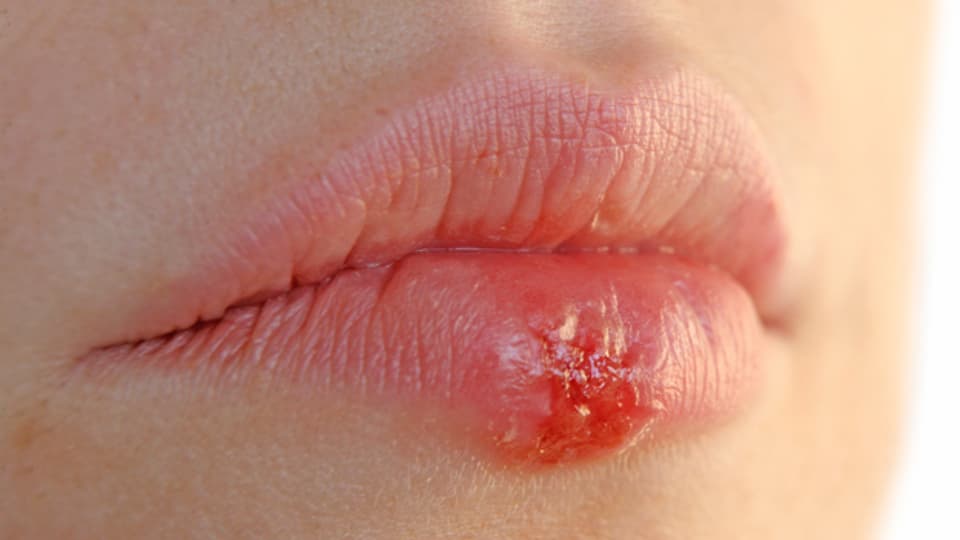 Bei Frauen können auch Zyklus bedingte Hormonschwankungen Ursache für Lippenherpes sein.