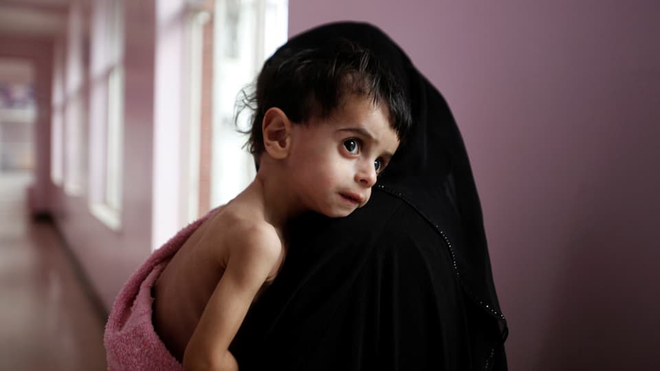 Ausgehungertes Kind in einem jemenitischen Spital. 