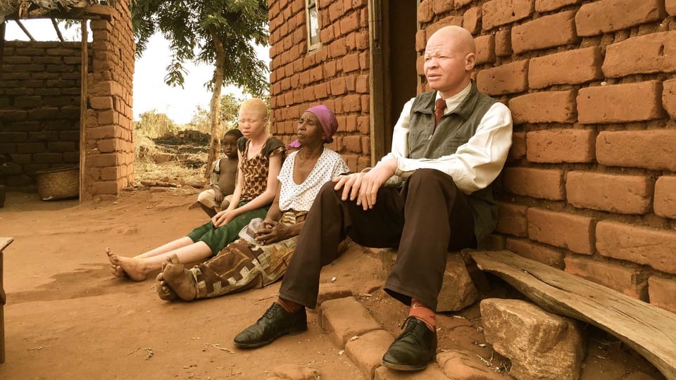 Zwei Albino-Menschen mit weiss-rosa Haut.