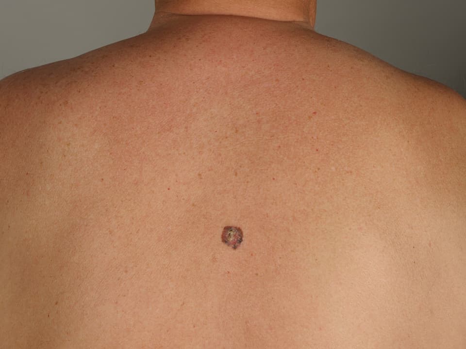 Schwarzer Hautkrebs auf einem Rücken.
