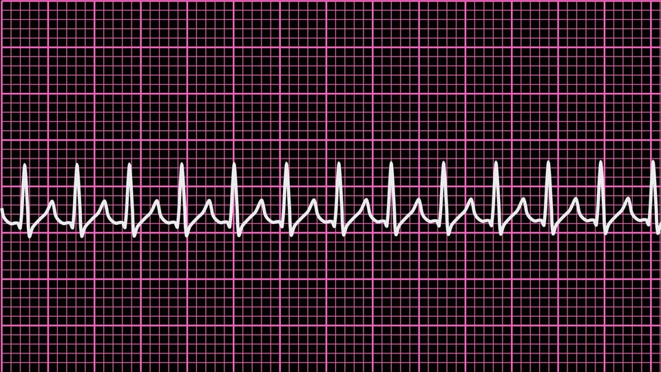 EKG-Bild des Herzrasens.