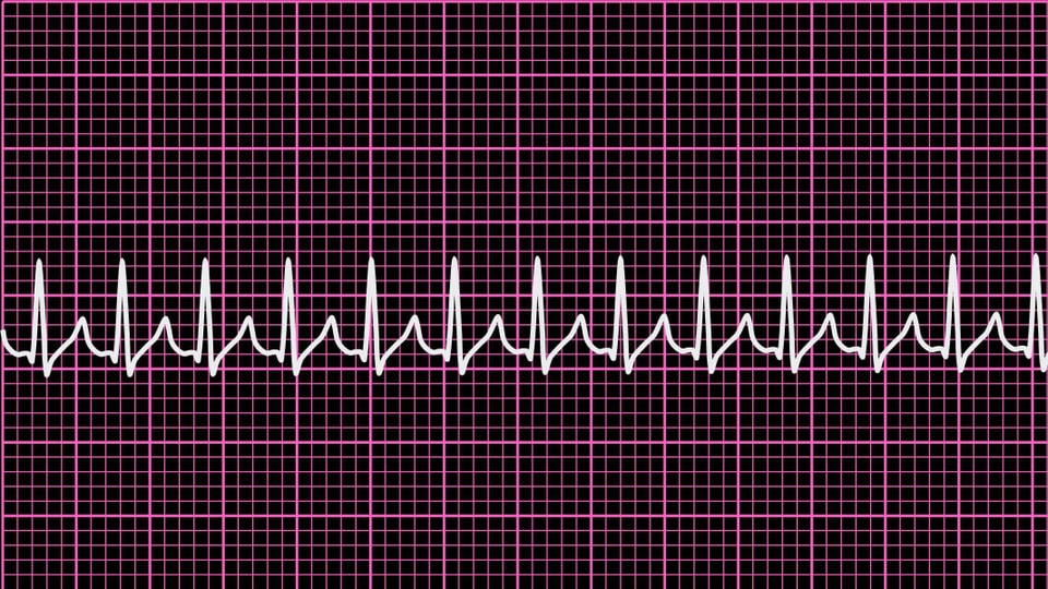 EKG-Bild des Herzrasens.