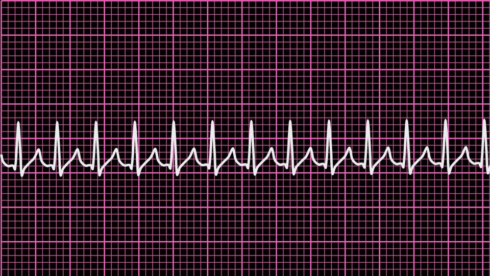 EKG-Bild des Herzrasens.