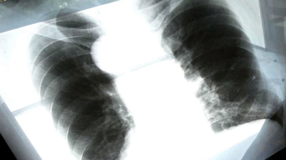 Röntgenbild einer Asbest-Lunge