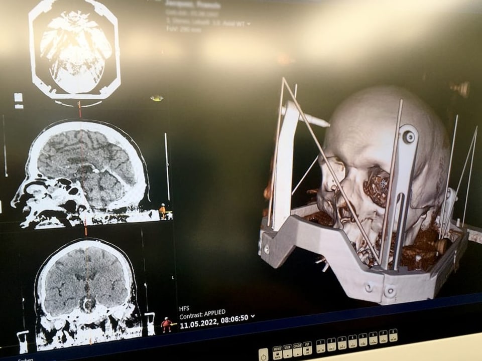 Strom gegen das Zittern Mit der tiefen Hirnstimulation den Tremor