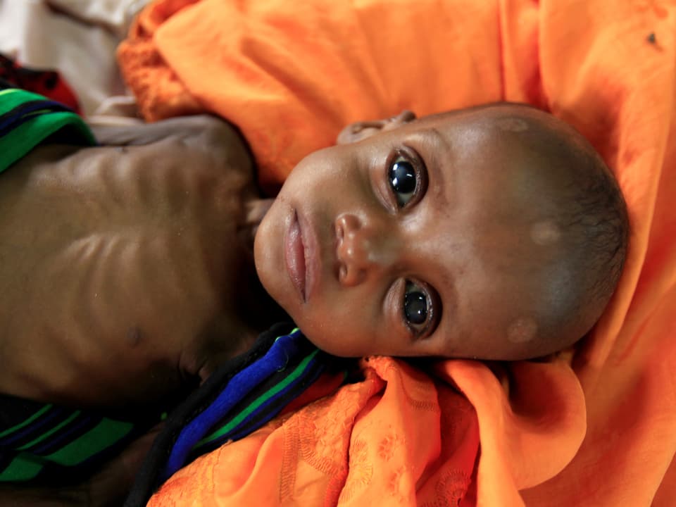Ein unterernährtes Kind, in einem Spital von Ärzte ohne Grenzen. 