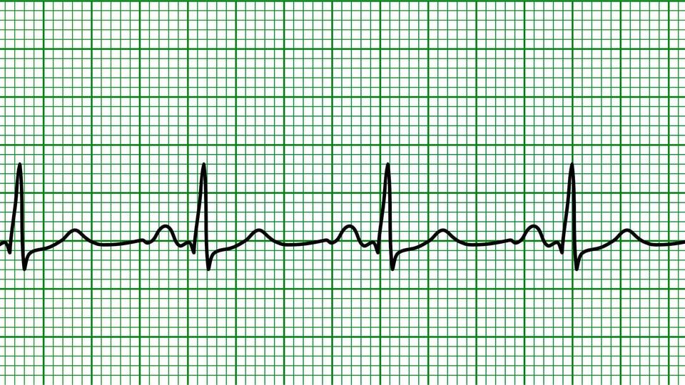 EKG eines normalen Herzschlags