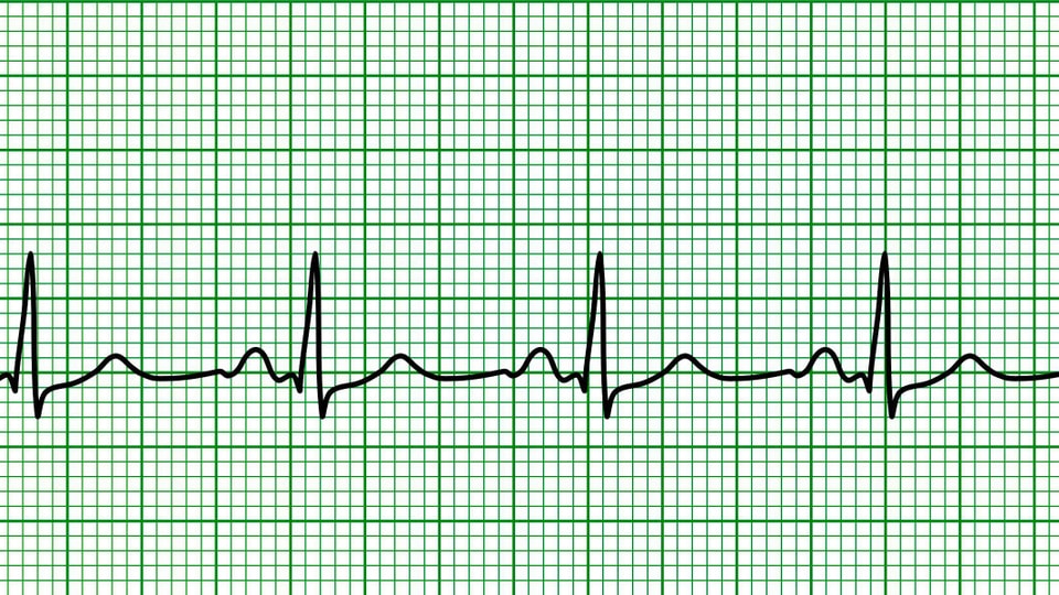 EKG eines normalen Herzschlags