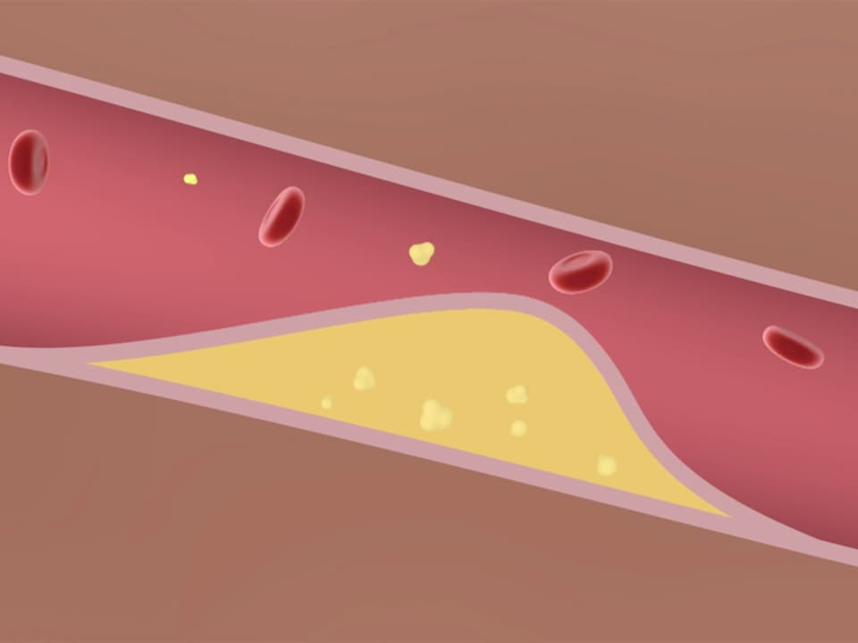 Grafischer Blick ins Innere eines Blutgefässes mit Ablagerungen