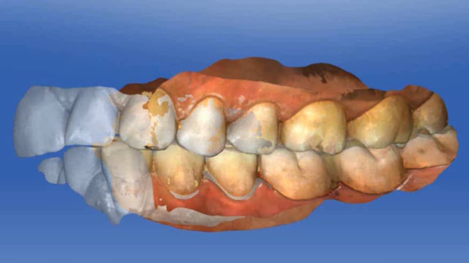 Ein am Computer rekonstruiertes Gebiss.