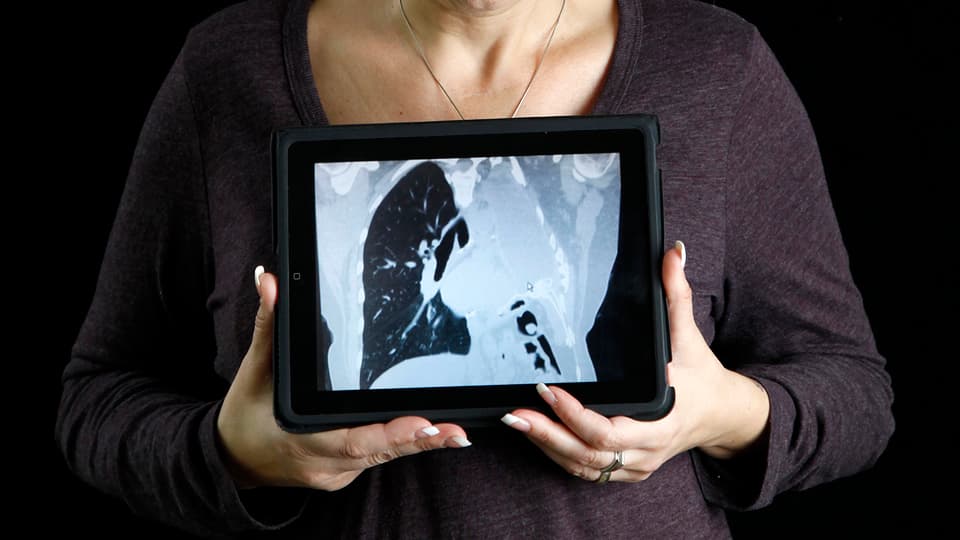 Hände halten vor dem Körper ein Tablet, darauf ein Röntgenbild mit nur einem Lungenflügel.