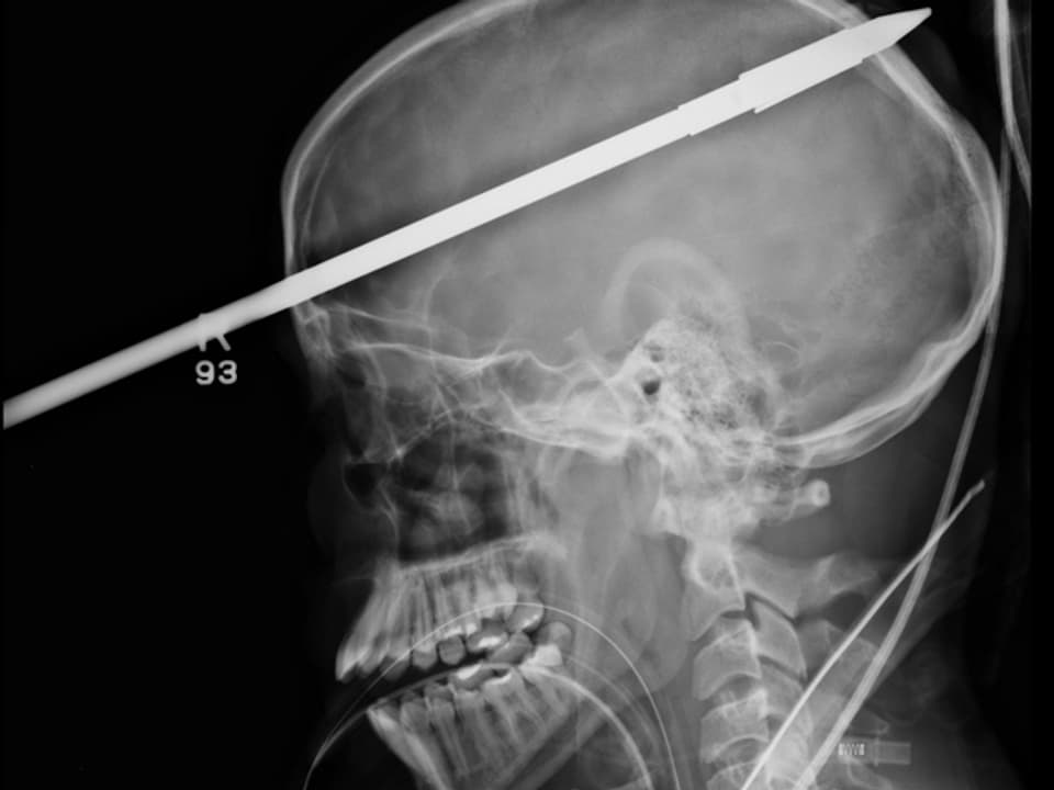 Röntgenaufnahme mit Harpunenspitze im Schädel.