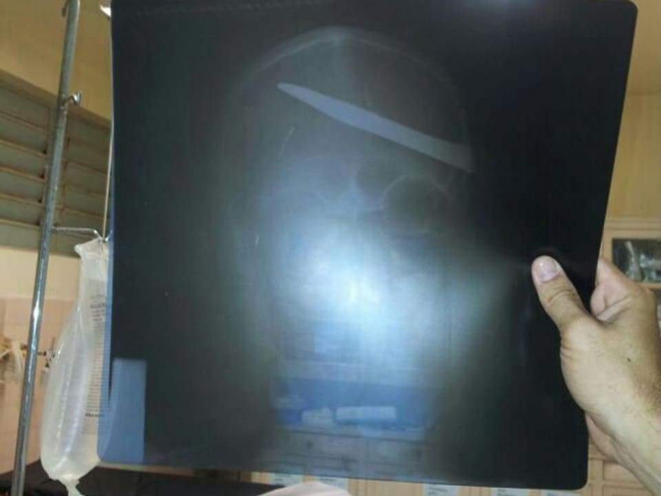 Röntgenbild mit Messer im Schädel.