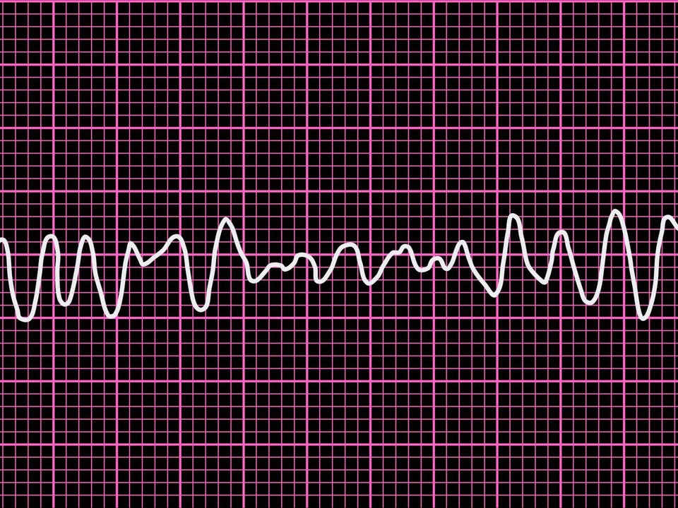 EKG-Aufzeichnung von Kammerflimmern.