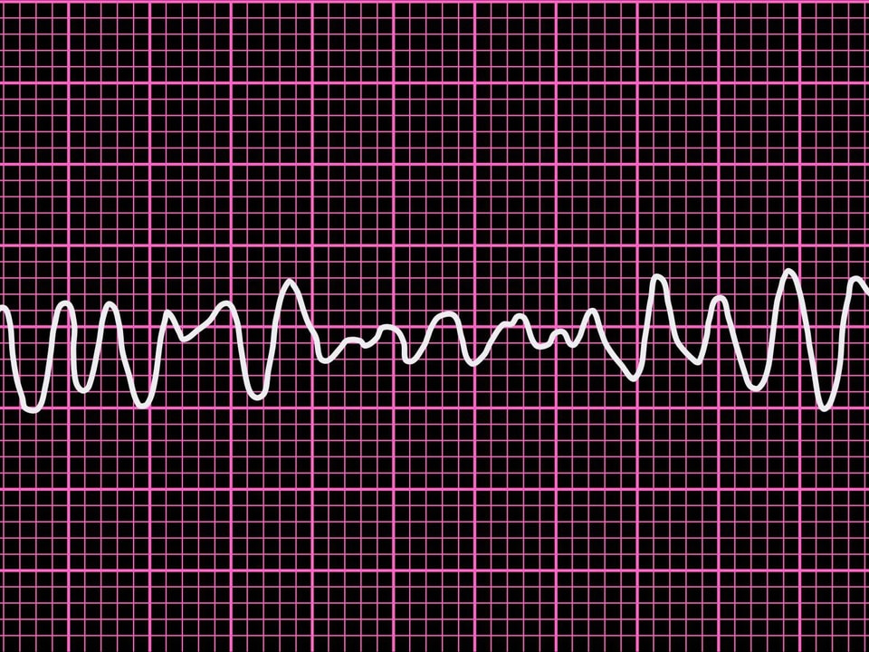 EKG-Aufzeichnung von Kammerflimmern.