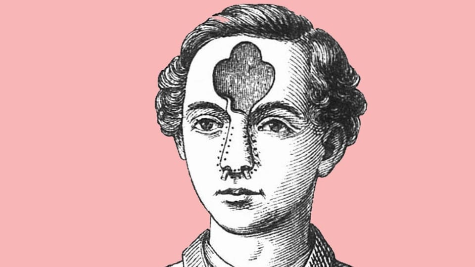 Zeichnung eines Mannes, dem auf der Stirn ein Stück Haut fehlt.