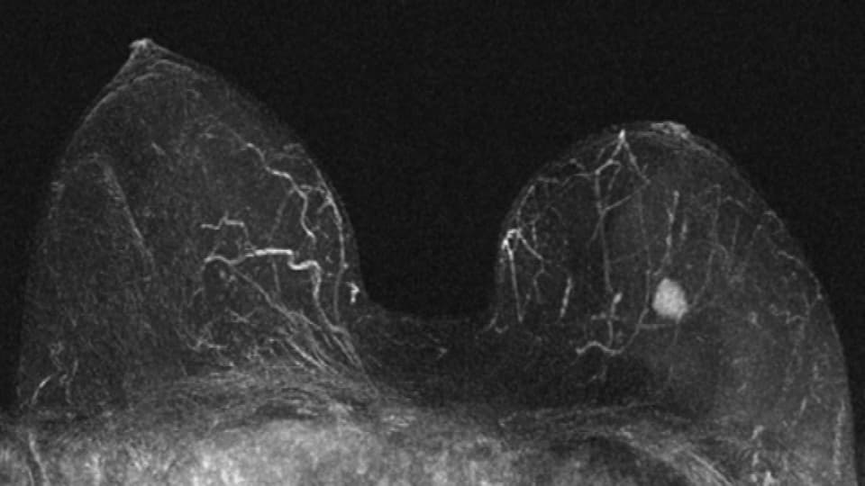 MRI-Scan einer Brust mit einem verdächtigen Knoten