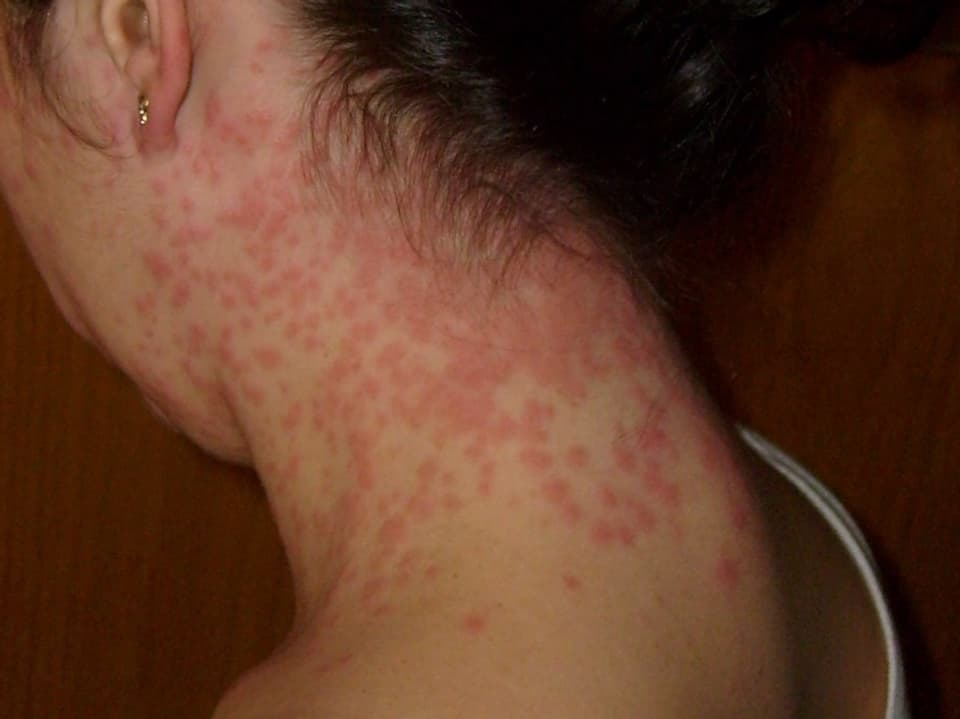 Rote Punkte auf der Haut am Hals eine Frau, die fast teilweise die ganze Haut bedecken.