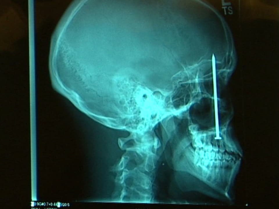 Röntgenaufnahme mit Nagel im Kopf.